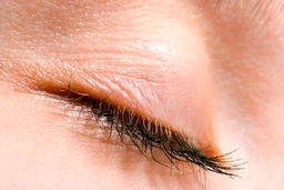 شکایت از کادر درمان بعد از مرگ زنی که جراحی پلک انجام داد