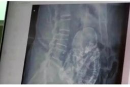 آمار تکاندهنده از سقط جنین عمدی