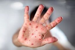 مشاهده سرخک در این استان/ ۴ مورد قطعی مثبت گزارش شد