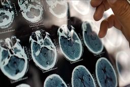 یک عامل مهم و کمتر گفته شده درباره روند پیشرفت آلزایمر

