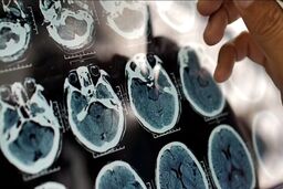 یک عامل مهم و کمتر گفته شده درباره روند پیشرفت آلزایمر

