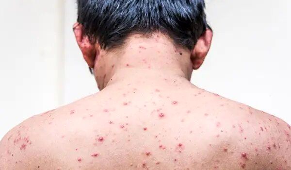 علائم آبله‌مرغان در بزرگسالان