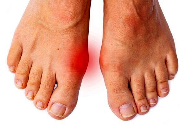 درد شست پا می‌تواند نشانه بیماری‌های جدی باشد