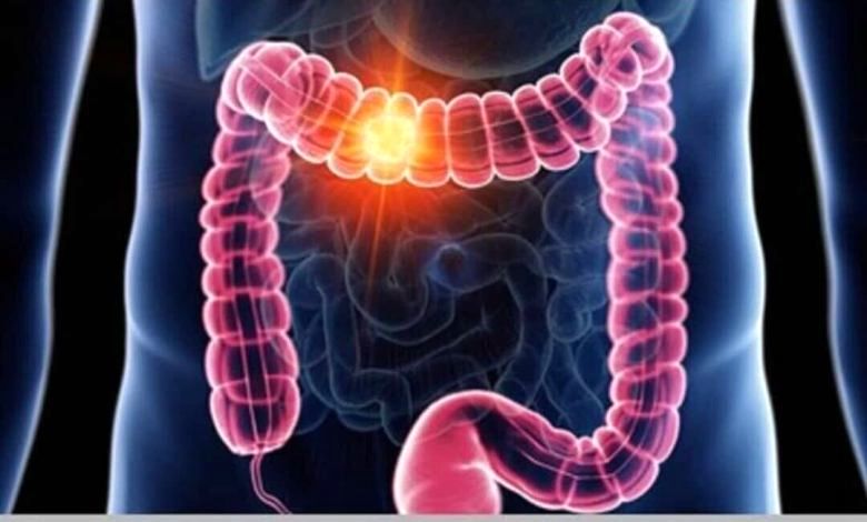 علائم گوارشی را ساده نگیرید/ هر خون‌ریزی هموروئید نیست