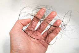 مهم ترین دلایل ریزش مو چیست و چگونه درمان می‌شود؟